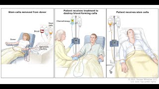 Typical Treatment of Acute Myeloid Leukemia [upl. by Asenej]