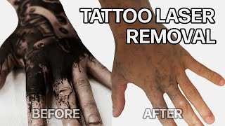 WHY DID I LASER OFF ALL MY TATTOOS  TATTOO LASER REMOVAL [upl. by Aiza]