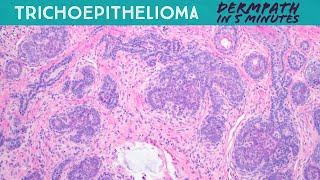 Trichoepithelioma  a hair follicle tumor Dermpath in 5Minutes pathology dermatology [upl. by Ede]