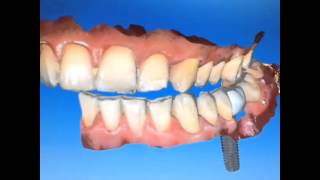 Implant abutment and crown design with CEREC [upl. by Tebazile]