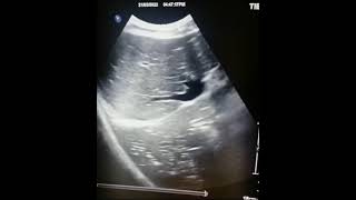 Ultrasound of pneumonitis with Hepatization of lung [upl. by Raamal743]