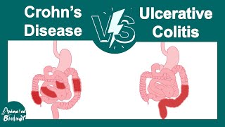 Crohns disease vs Ulcerative colitis  Pathology  USMLE step 1 [upl. by Garlanda]