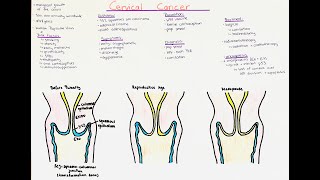 Cervical Cancer  oncogenesis histology clinics [upl. by Tristas]