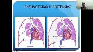 Aula sobre pneumotórax e diagnósticos diferenciais [upl. by Ytinav]