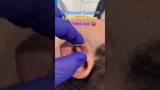 Massive blackhead extraction skincare blackheadremoval Dr Khaled Sadek [upl. by Keheley130]