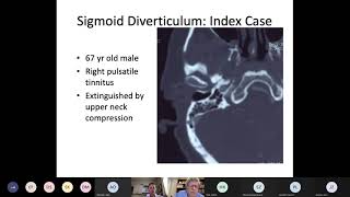 Pulsatile Tinnitus Dr Douglas Mattox Emory University [upl. by Eah]