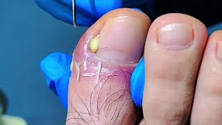 Patient Almost Cries When Deep Ingrown Toenail and Shocking Leg Hair Get Removed [upl. by Ping173]