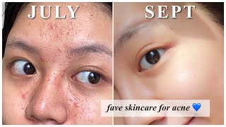 Rekomendasi Skincare utk Jerawat kombinasi berminyak [upl. by Lange]