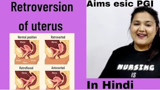 Retroversion of uterus Degrees of retroversion For medical students in Hindi [upl. by Ellon236]