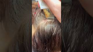 Scalp Treatment for Eczema [upl. by Nbi35]