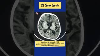 ill defined hypodensity BL periventricular region ctscan cva radiology [upl. by Annwahs]