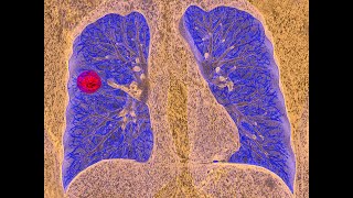 How to Treat Small Cell Lung Cancer [upl. by Urbanna355]