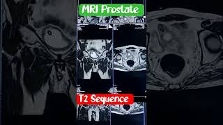 MRI prostate mri ctscan [upl. by Mad]