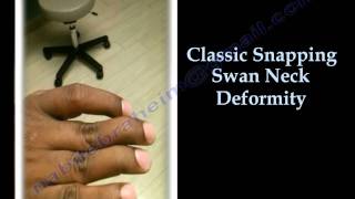 Swan Neck Deformity Classic Snapping  Everything You Need To Know  Dr Nabil Ebraheim [upl. by Nayek580]