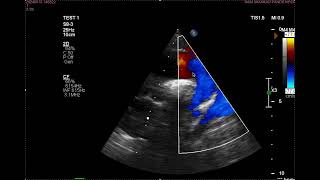 Bicuspid aortic Valve [upl. by Broek]