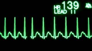 Sinus Tachycardia [upl. by Ecirrehs]