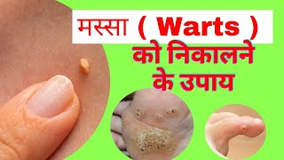 मस्सा  Warts के कारण व हटाने के घरेलू इलाज  massa  warts  type of warts [upl. by Gabby886]