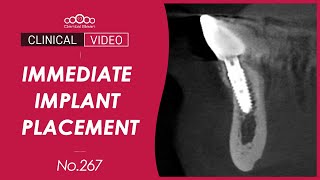 42 Immediate implant placement after extraction Dr Jeon Inseong [upl. by Peonir563]