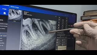 EXTRACTION AND ENUCLEATION OF BONE OF LEFT MANDIBULAR SECOND MOLAR TEETH [upl. by Alekim]