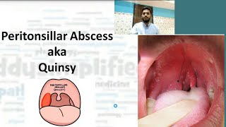 Quinsy  Peritonsillar abscess  ENT  Throat  Meddysimplified [upl. by Danieu]