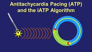 Antitachycardia Pacing ATP  How it Works How to Improve [upl. by Griff]