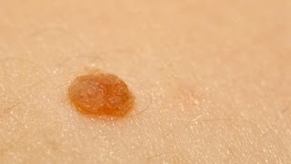 How to Examine Skin Growths for Cancer  Skin Cancer [upl. by Laurence891]