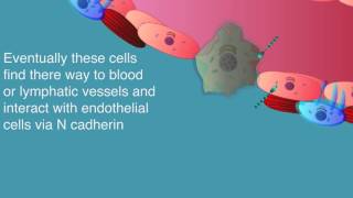 epithelialmesenchymal transition of metastasis [upl. by Kabob]