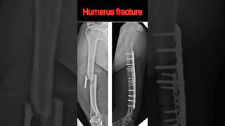 Humerus fracturevairalvideo anatomy radiological [upl. by Skerl]