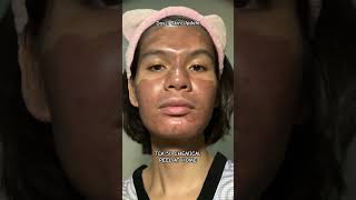 Day 1  TCA 50 CHEMICAL PEEL AT HOME  AT HOME ACNE SCARS TREATMENT diy [upl. by Let]