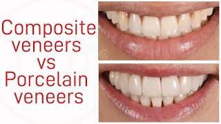 Composite veneers vs Porcelain veneers [upl. by Cirdla]