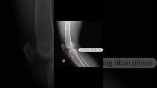 SalterHarris type II fracture proximal tibia xray shoets [upl. by Roswald]