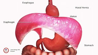 Surgery for acid reflux  Animation Video [upl. by Fifine173]