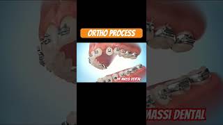 Braces Process [upl. by Pattison]