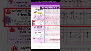 ECG EKG Rhythms to Know Sinus Rhythms Sinus Tachycardia Heart blocks etc [upl. by Lorilee]