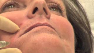 FractionalCO2 Laser and Juvedermdemonstration [upl. by Icyak]