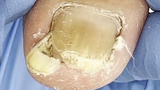 Obvious lesions of toenails treatment of onychomycosis【Xue Yidao】 [upl. by Seow658]