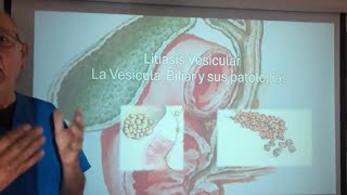 Cálculos en la Vesícula Biliar Tríada de Charcot Teoría Micelar formación del cálculo Dx y Semio [upl. by Lledra]