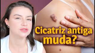 Como tratar uma cicatriz queloide ou hipertrófica antiga  Opinião de Esteticista [upl. by Orna]