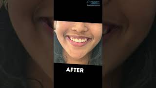 Gummy smile We’ve got the perfect nonsurgical solution 💖 gummysmiletreatment beforeandafter [upl. by Ginder]