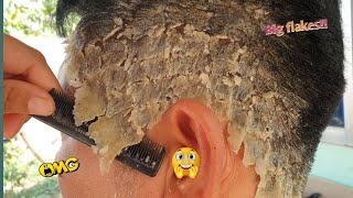 Psoriasis Scalp Removal At Home 350 [upl. by Udela]