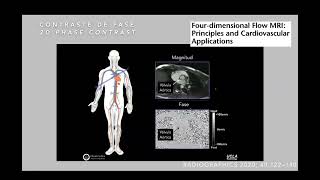 Resonancia Magnética Cardiaca 4D flow en cardiopatías congénitas [upl. by Ajat]