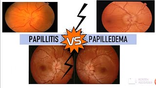 PAPILLITIS vs PAPILLEDEMA [upl. by Kare702]