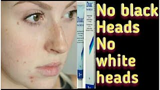 Best jel for acnecyst scars whiteheads and blackheads [upl. by Asiel833]