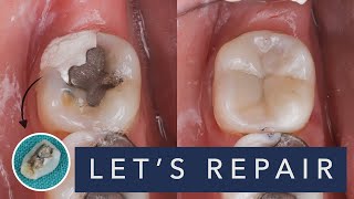 Filling Replacement Composite filling on the last molar [upl. by Nnylyt621]