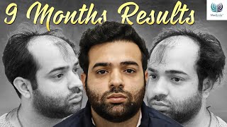 JawDropping 9Month Hair Transplant Transformation  Medlinks Hair Transplant Delhi [upl. by Darline]