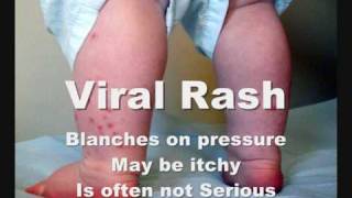 How To Check Meningitis Rash [upl. by Lilla]