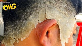 Itchy Psoriasis Scalp Removal At Home 191 [upl. by Leventis]