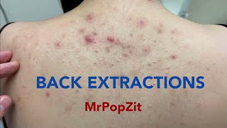 Tons of blackheads on the back Acne extractions Blackheads and whiteheads Mining pore dirt [upl. by Dalis]