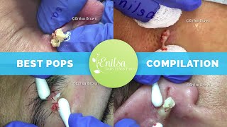 Enilsas Top 5 Best Cyst Popping Compilation [upl. by Adlanor]