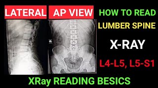 lower back x ray how read L4 L5 S1 lambosacral x ray reading Techcpd [upl. by Carpenter]